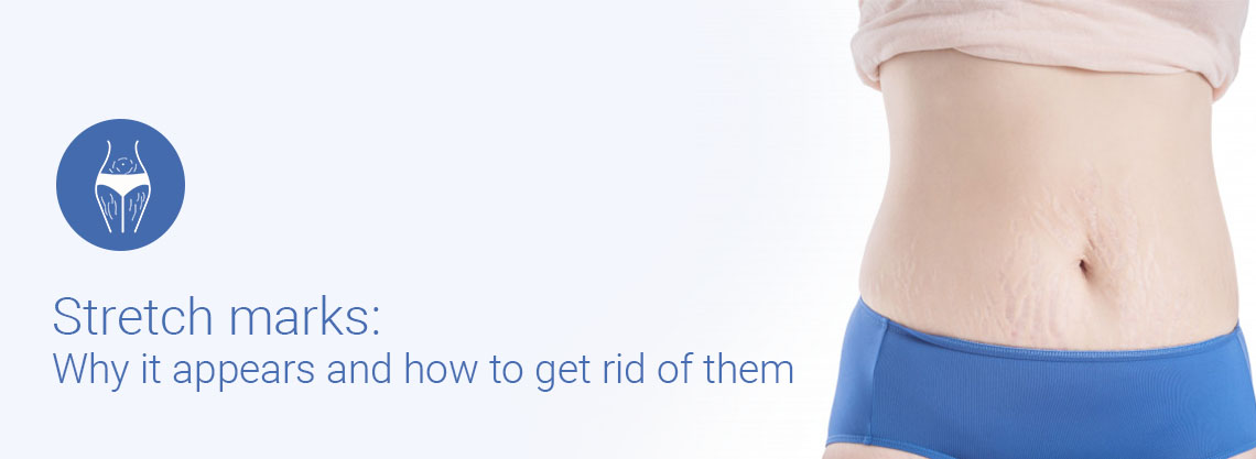 Stretch marks removal treatment